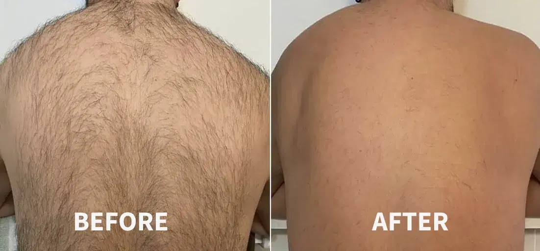 Before and after laser hair removal treatment at Highland Glo Med Spa