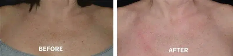 Before and after décolletage rejuvenation treatment at Highland Glo Med Spa