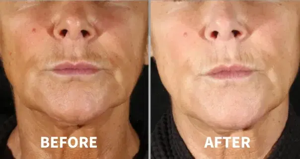 Before and after facial skin tightening treatment at Highland Glo Med Spa