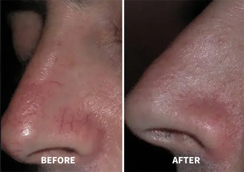 Before and after facial vascular treatment at Highland Glo Med Spa