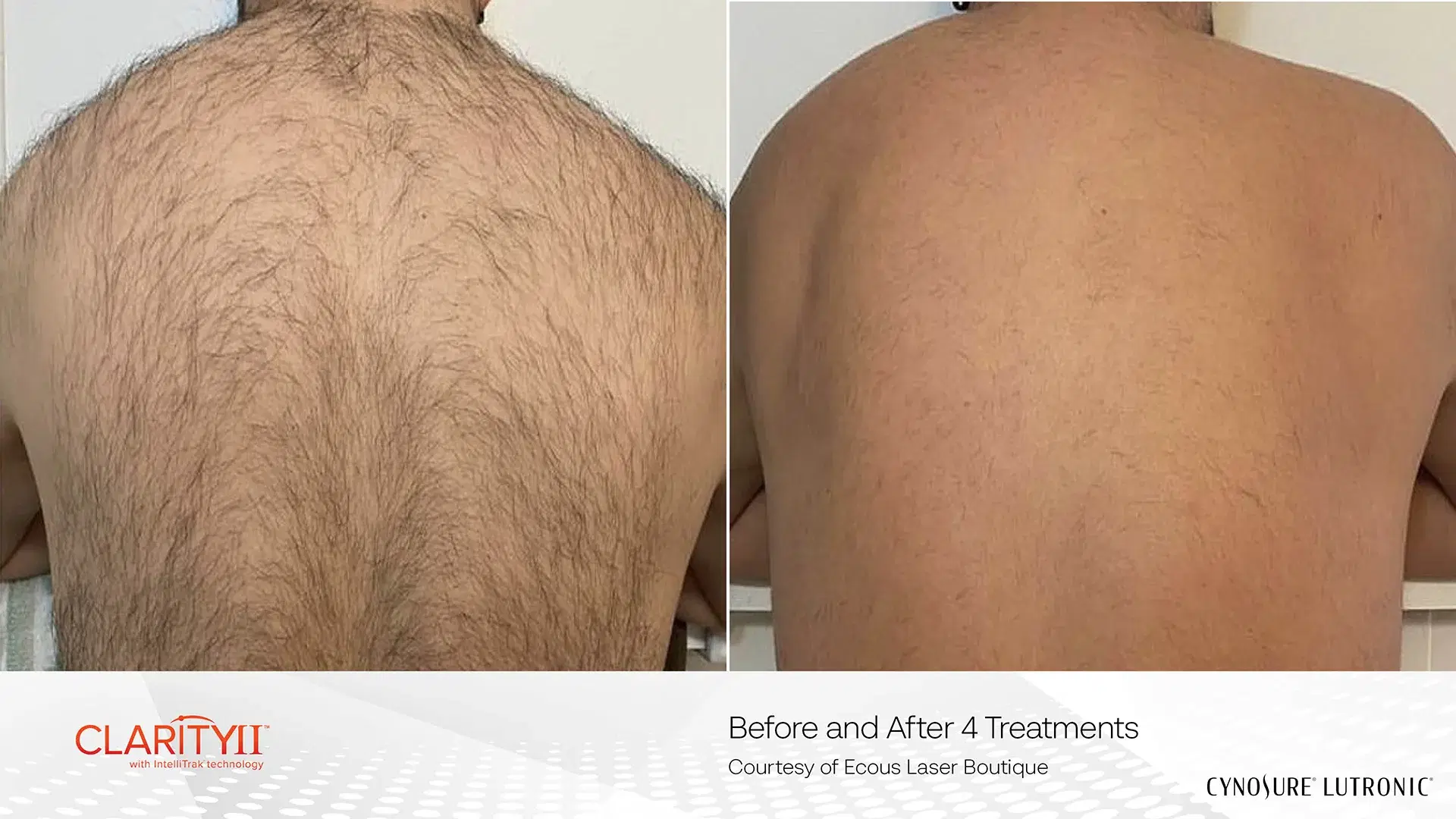 Before and after laser hair removal treatment at Highland Glo Med Spa