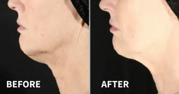 Before and after jaw & neck tightening treatment at Highland Glo Med Spa