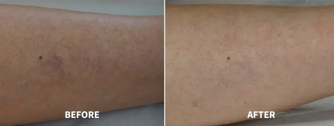 Before and after leg vein removal treatment at Highland Glo Med Spa