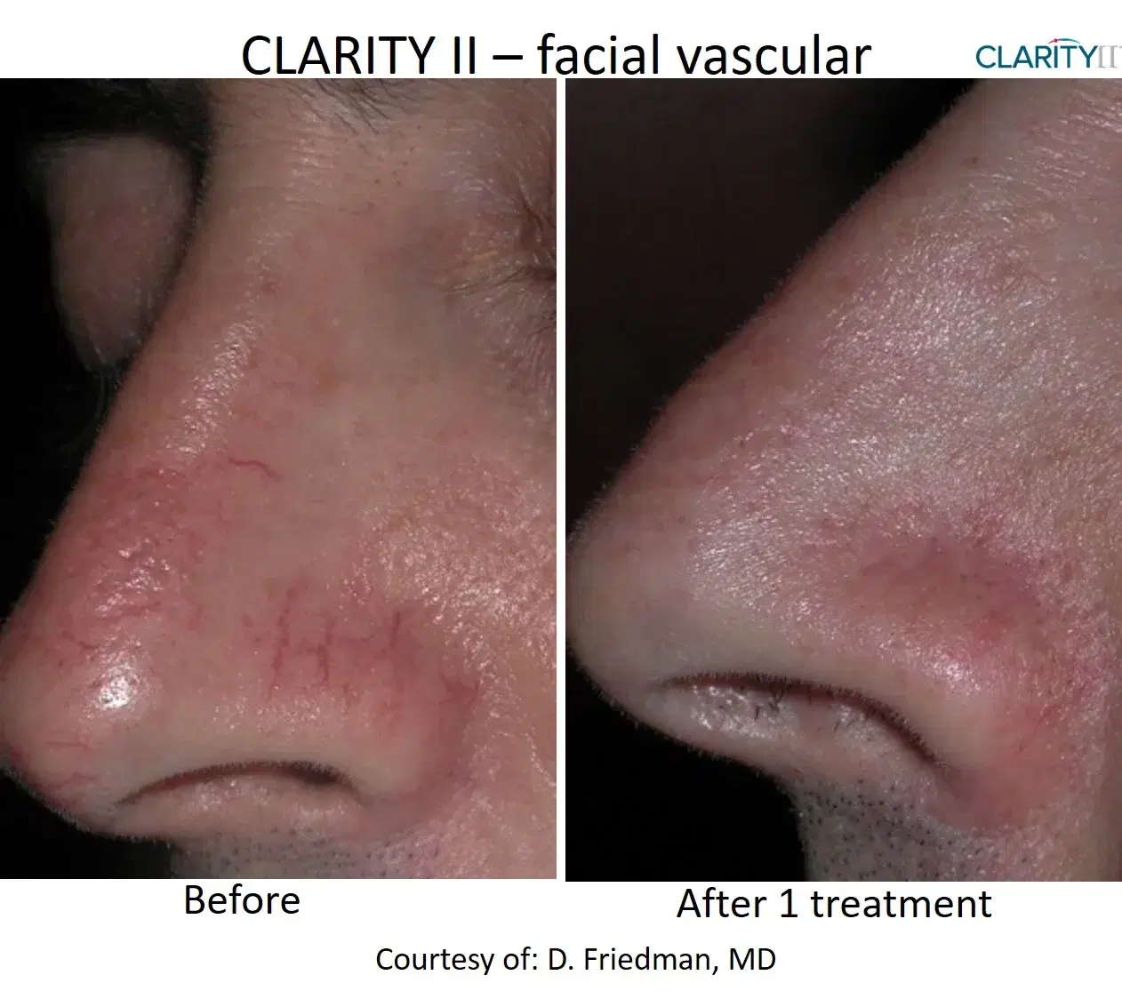 Before and after facial vascular treatment at Highland Glo Med Spa
