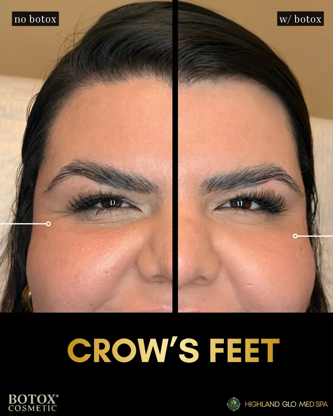 Before and after botox® cosmetic with BOTOX® Cosmetic at Highland Glo Med Spa