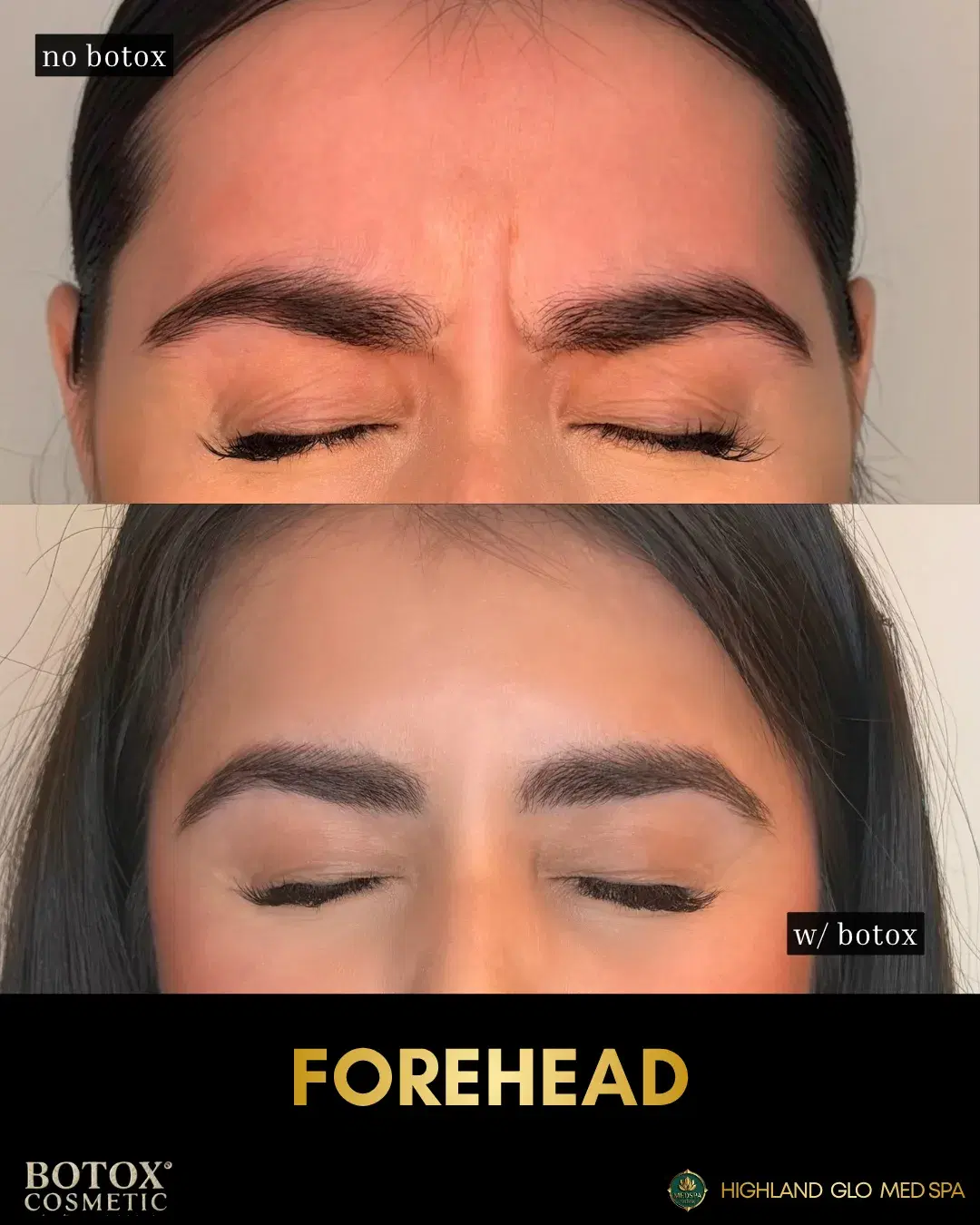 Before and after botox® cosmetic with BOTOX® Cosmetic at Highland Glo Med Spa