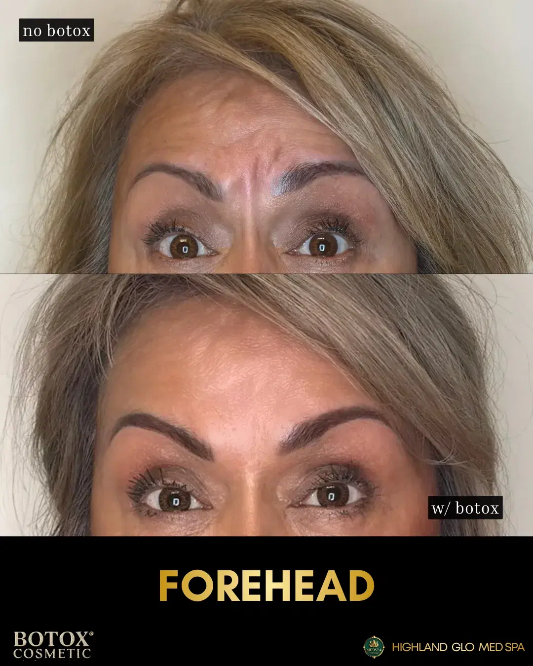 Before and after botox® cosmetic with BOTOX® Cosmetic at Highland Glo Med Spa