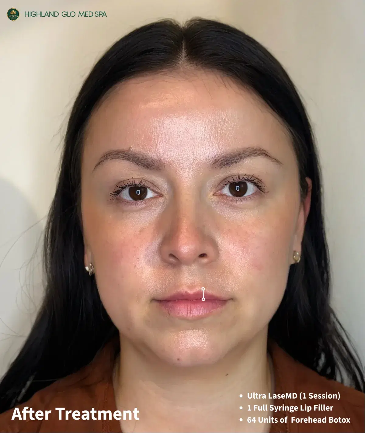 Front-view results after full-face rejuvenation at Highland Glo Med Spa