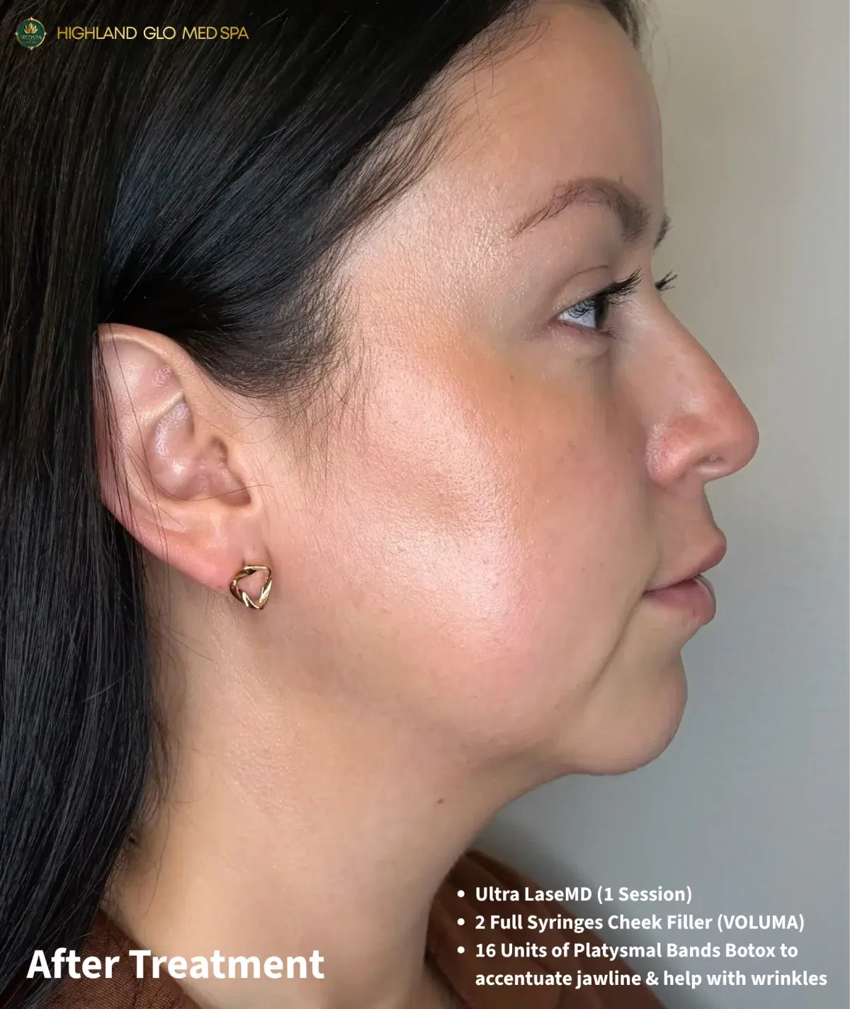 Side-view results after full-face rejuvenation at Highland Glo Med Spa
