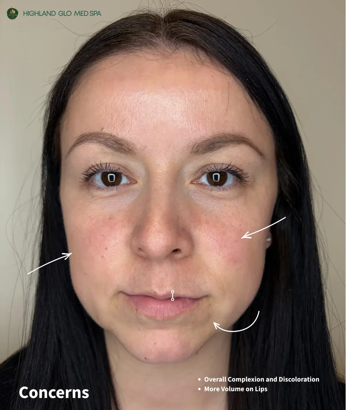 Front-view concerns before full-face rejuvenation at Highland Glo Med Spa