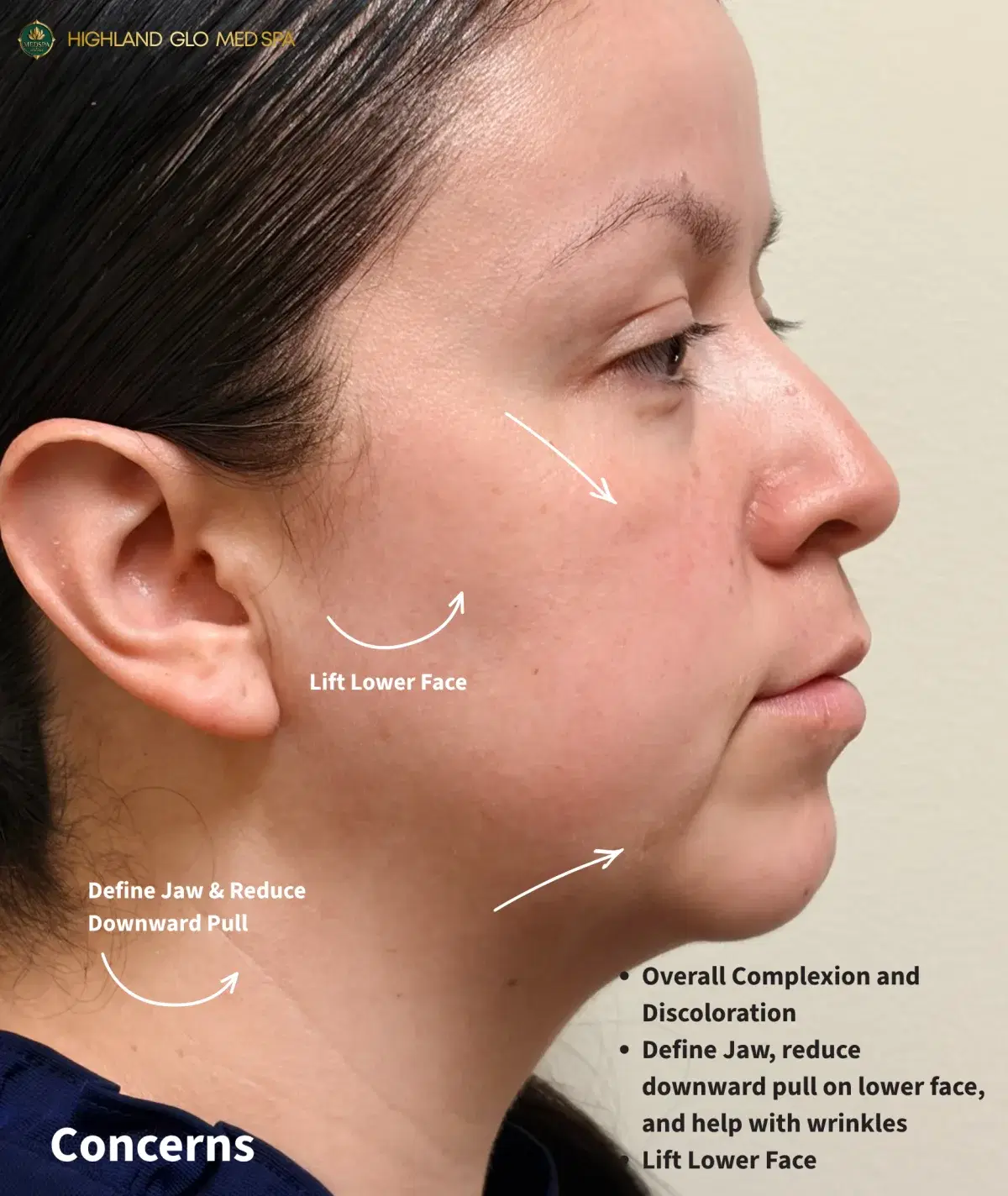 Side-view concerns before full-face rejuvenation at Highland Glo Med Spa