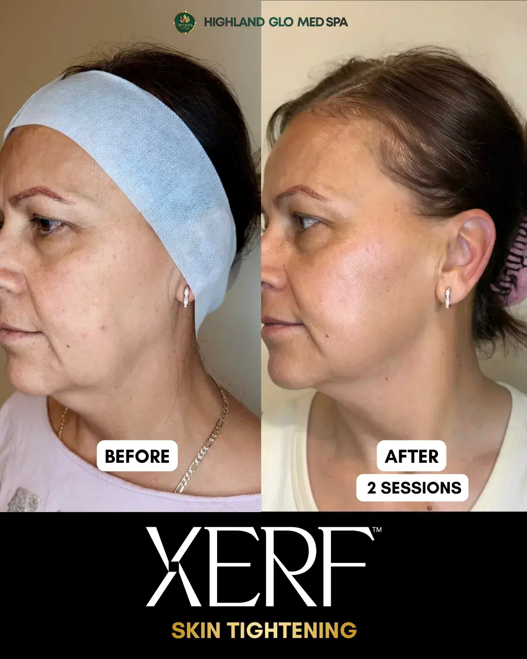 Before and after skin tightening with XERF at Highland Glo Med Spa